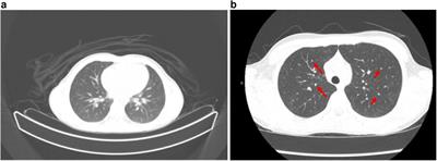 A case report navigating CVID and sarcoidosis overlaps in pediatric nephritis